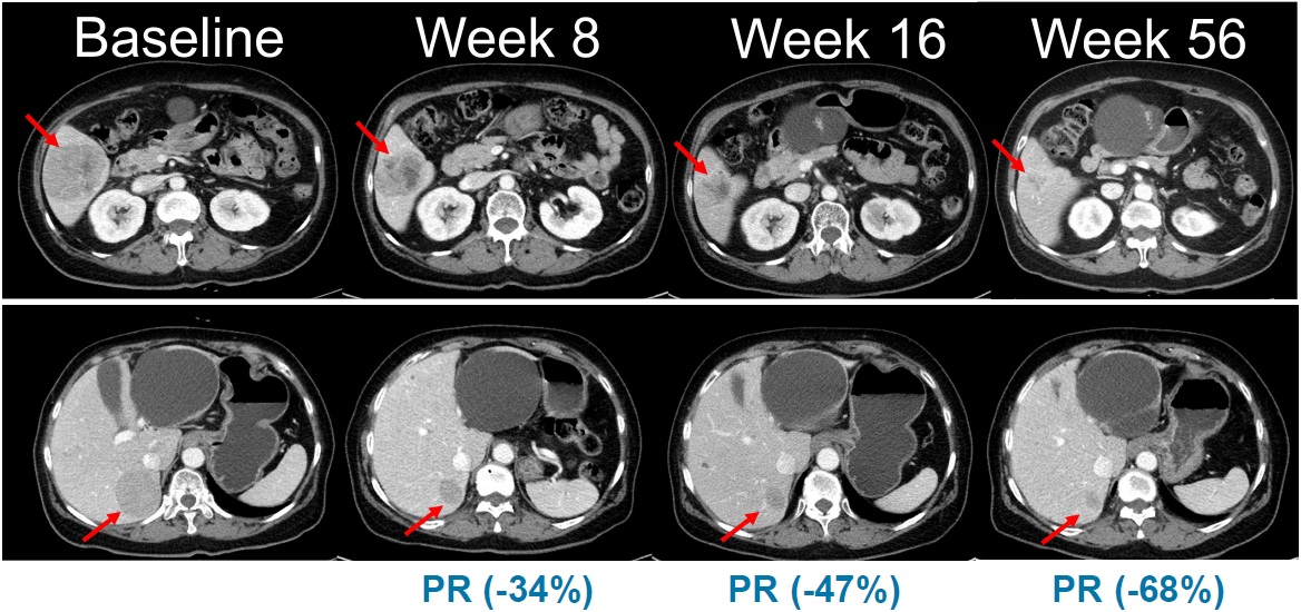 Abdominal CT images showing changes in tumor lesions over time in a clinical trial evaluating combination therapy with b